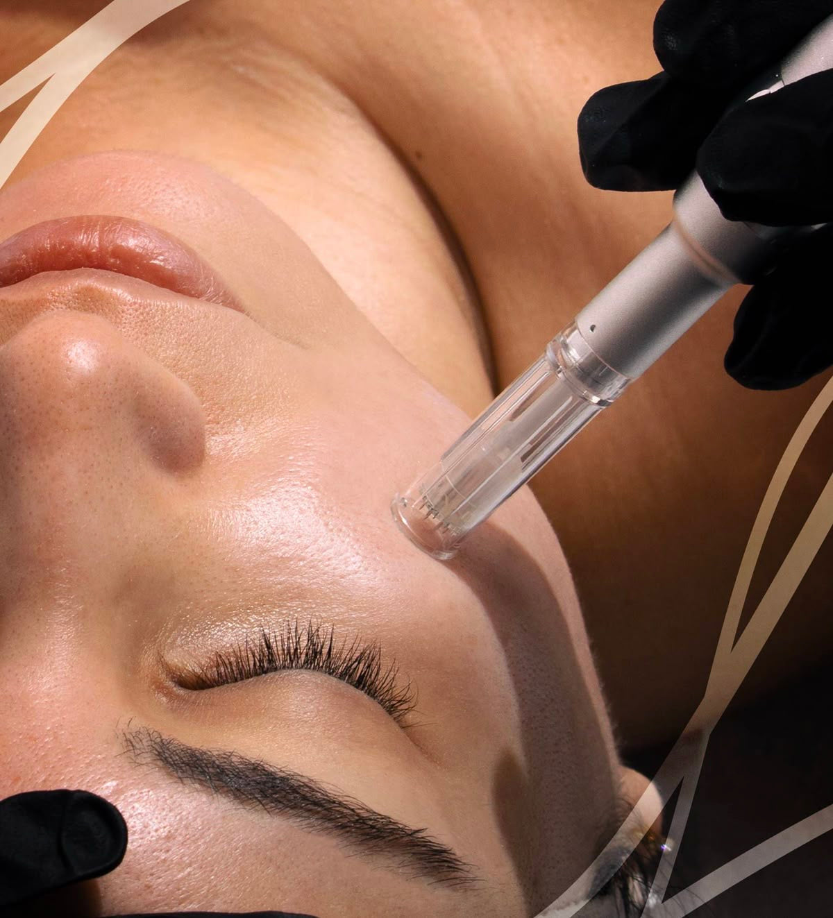 ✨Microneedling (Dermapen)✨